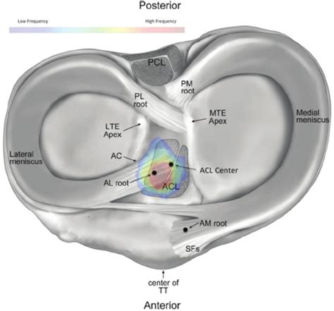 lateral menisküs anterior ve posterior hornlarında grade 2 dejenerasyon